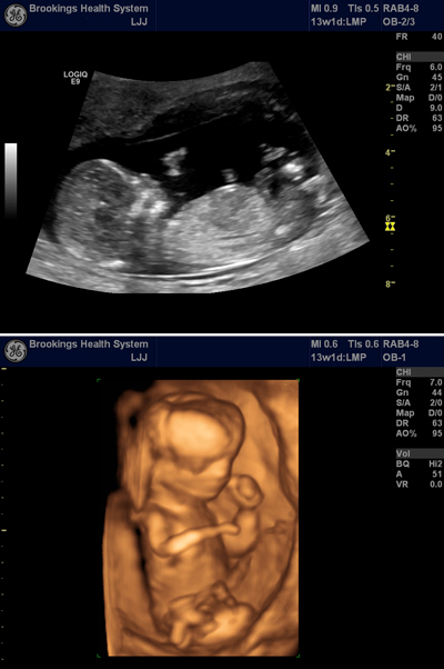 First trimester pregnancy screenings at Brookings Health System identifies pregnancies at high risk for specific chromosomal abnormalities. The screenings, which are performed at 11 to 13 weeks in a woman’s pregnancy, combine a maternal blood screening test with an ultrasound, such as the ones pictured above.