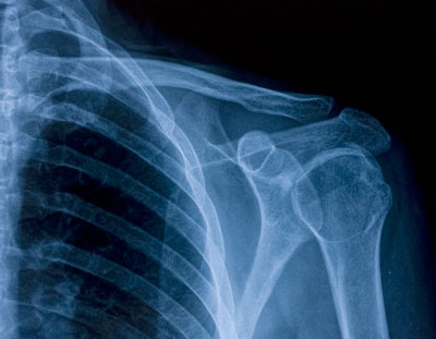 X-ray of shoulder