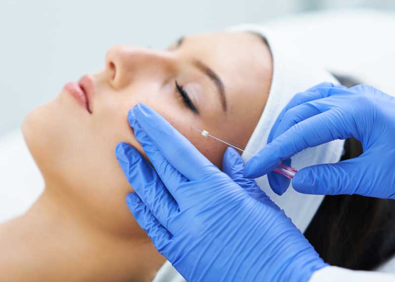 Polydioxanone (PDO) threads are injected into skin using hypodermic needles, as shown in the photo above, to tighten and lift sagging skin in the jaw, cheek and neck area. The FDA-approved procedure, sometimes referred to as a mini facelift, is now available at Näva Medical Spa. PDO thread lifts are a less invasive alternative to facelift surgery, with results typically lasting four to six months. 