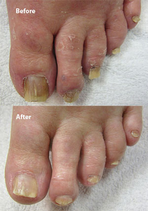 Patient-1_before-and-after_whole-foot.jpg
