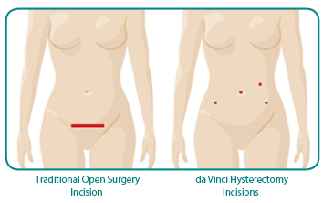 Illustration of da Vinci incisions versus open incisions