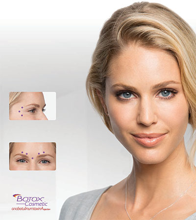 Botox Patient Brochure Image