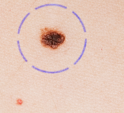 White Medical Clinic will hold a free melanoma cancer screening on Wednesday, May 21 at Corner Gas & Goodies in White. Melanomas, like the one pictured above, often resemble moles and should be checked by a health care professional. When detected early, melanoma skin cancer is almost always curable.